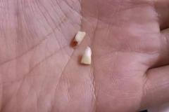 做梦梦见牙齿掉了两个 男人梦见自己掉牙2颗