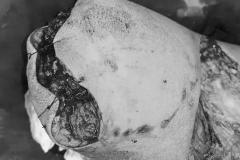 周公解梦梦见自己双腿截肢 梦见截肢是否代表健康有问题