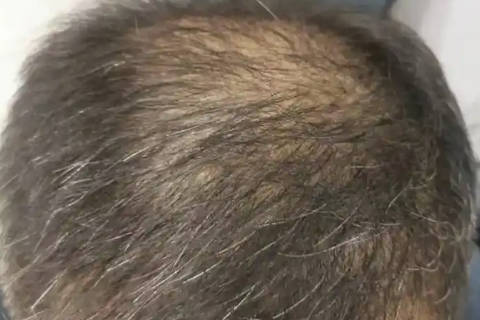 梦到自己头发稀疏 是吉兆还是凶兆