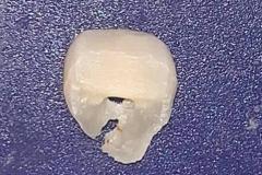 梦见自己牙碎了一颗 牙齿碎了是不是真的会有坏事发生