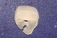 做梦牙齿掉了是什么预兆 梦见牙齿全部脱落并吐出来